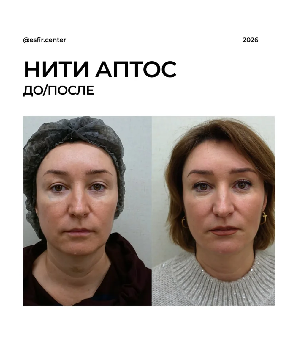 Коррекция второго подбородка нитями Aptos: фото 1