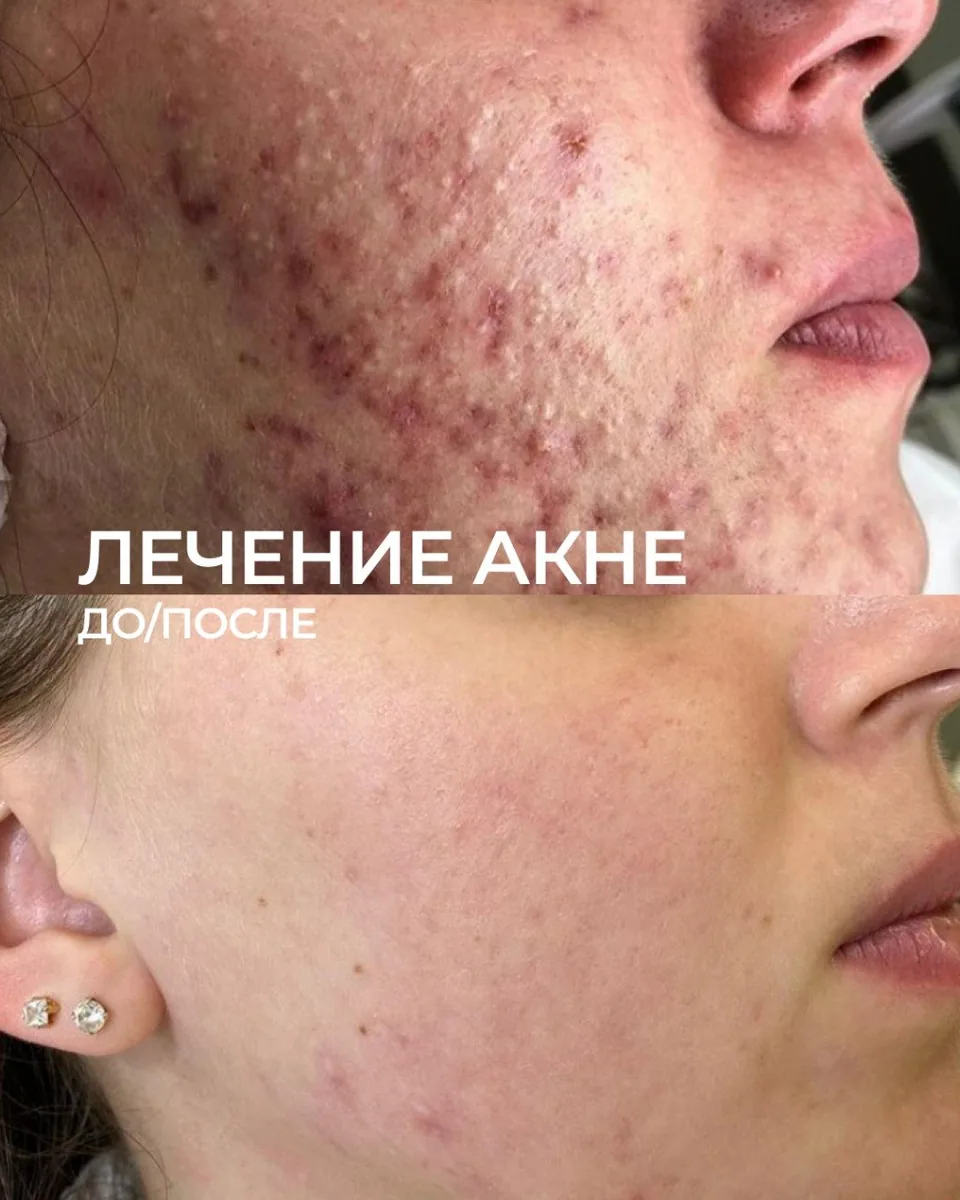 Лечение акне: фото результата 2